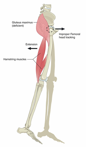 Hip mechanics diagram showing gluteus maximus and improper femoral head tracking