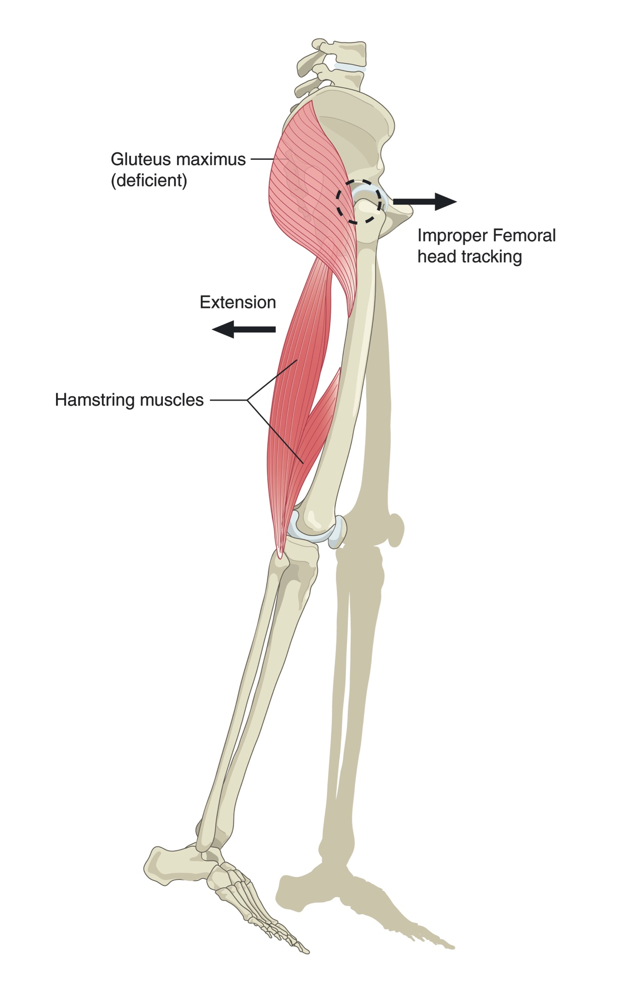 Anterior femoral glide syndrome: the thigh bone sliding forward in the hip socket