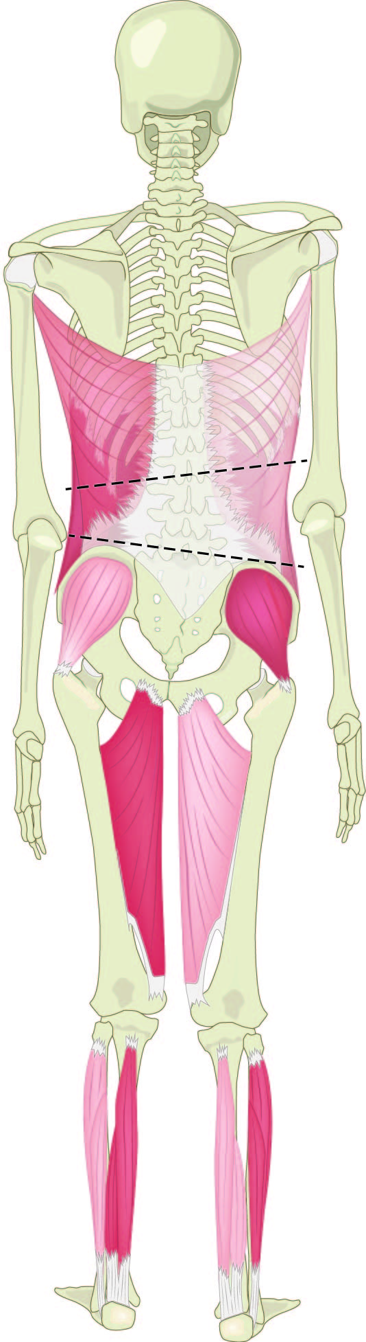 A Sidebending Problem: uneven pelvis and rib cage from compensating for a painful hip