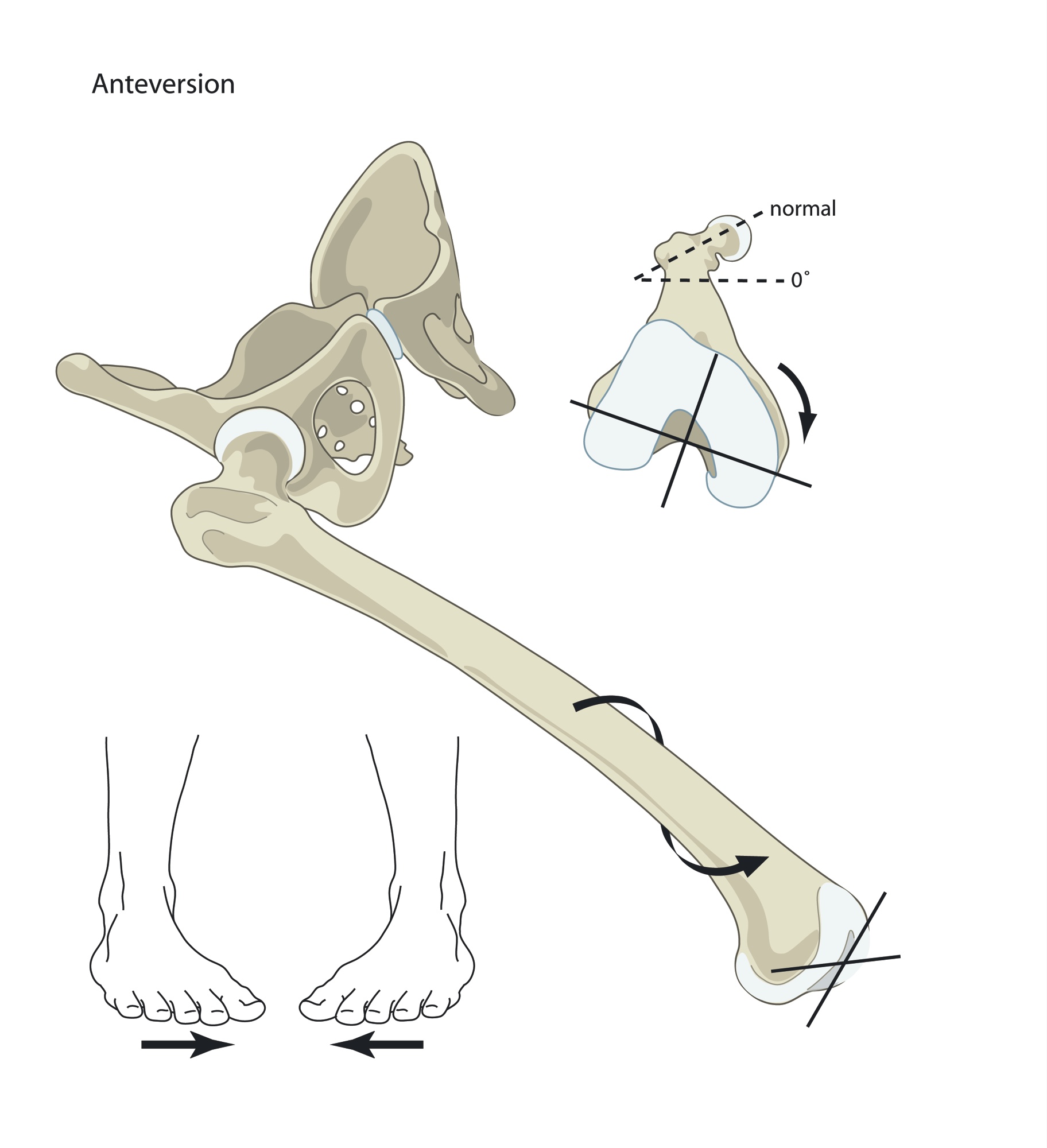 Femoral anteversion
