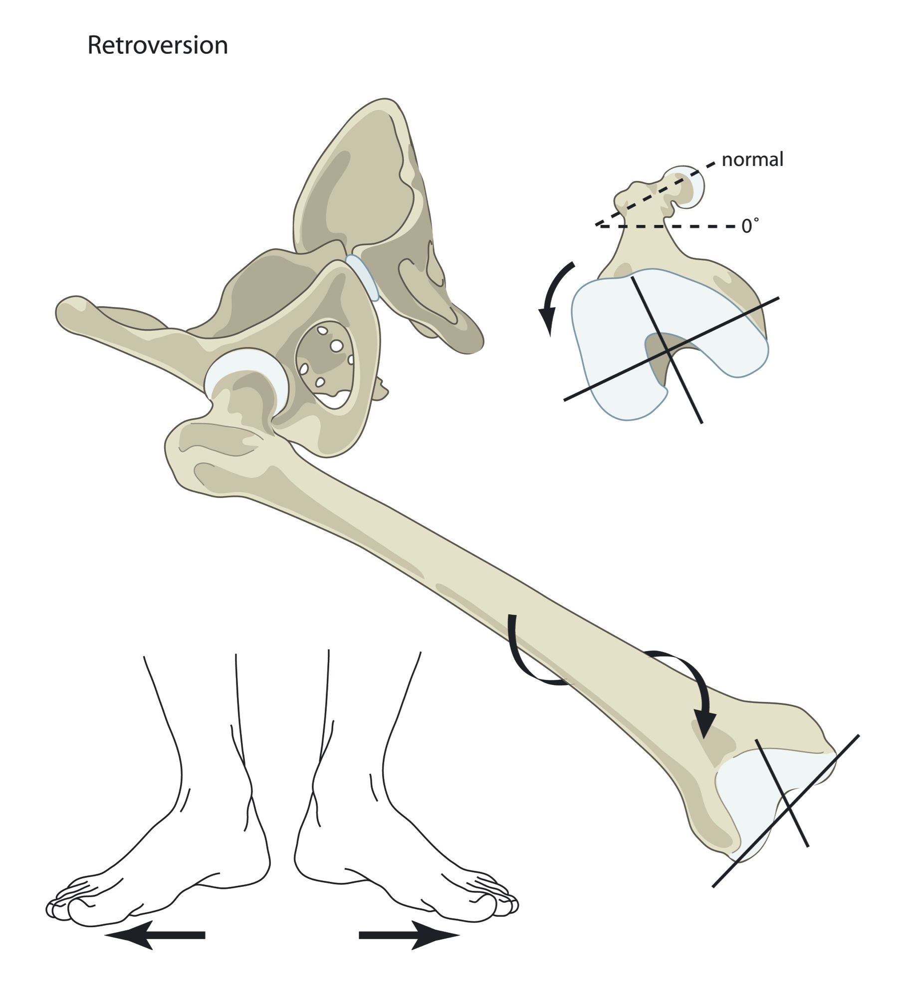 Femoral retroversion: the thigh bone rotated outward at the hip