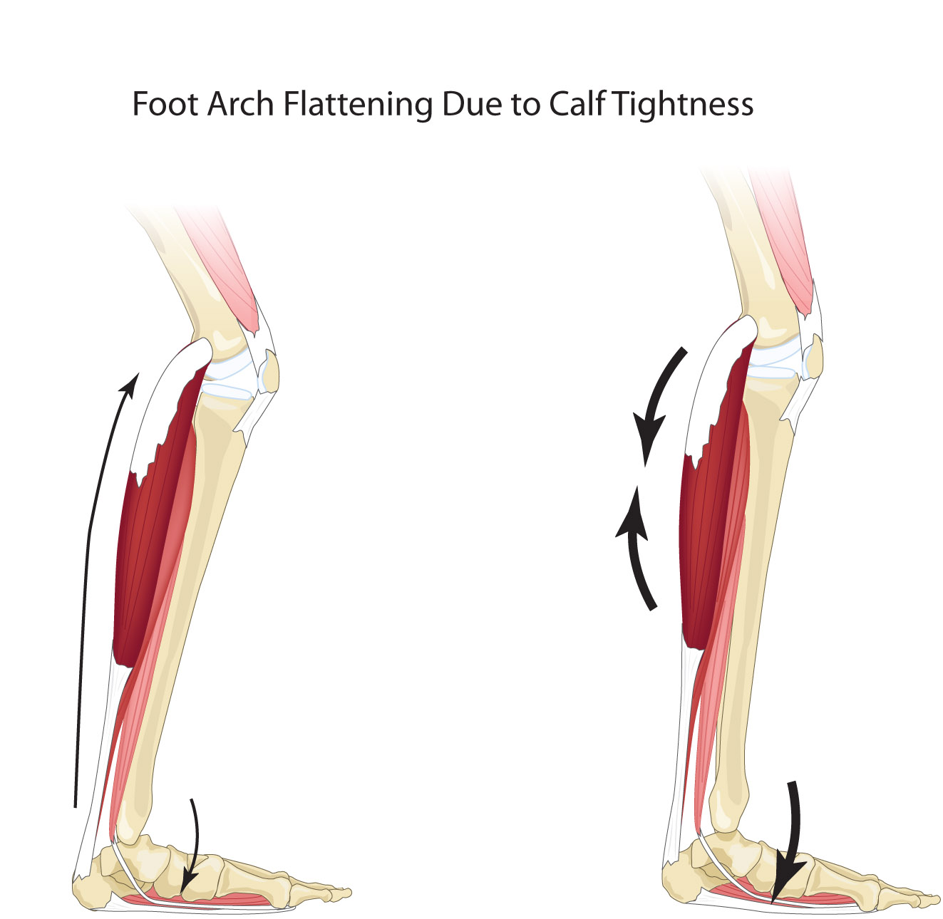 Stress delivered to the foot and arch when tight calf and soleus muscles stop the knee moving forward over the foot