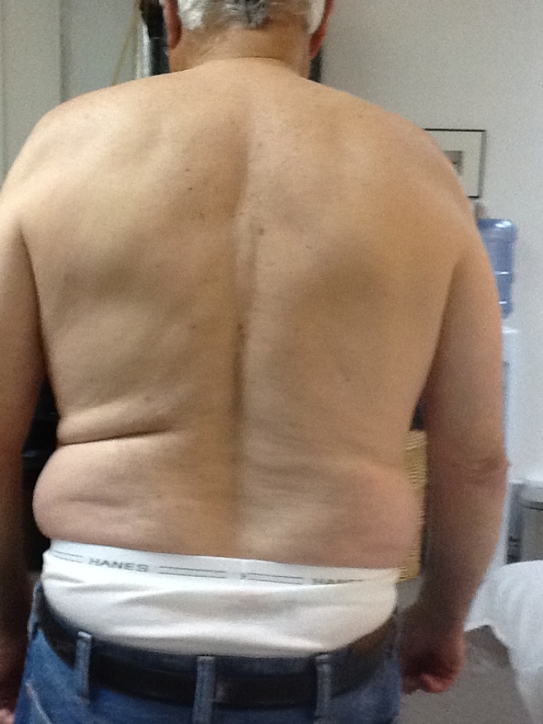 A left sidebending problem: deeper waist crease on the left
