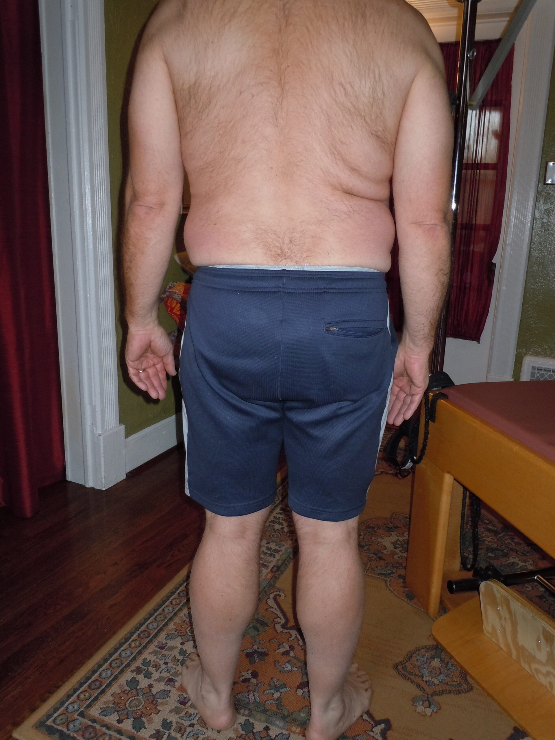 A right sidebending problem: deeper waist crease on the right