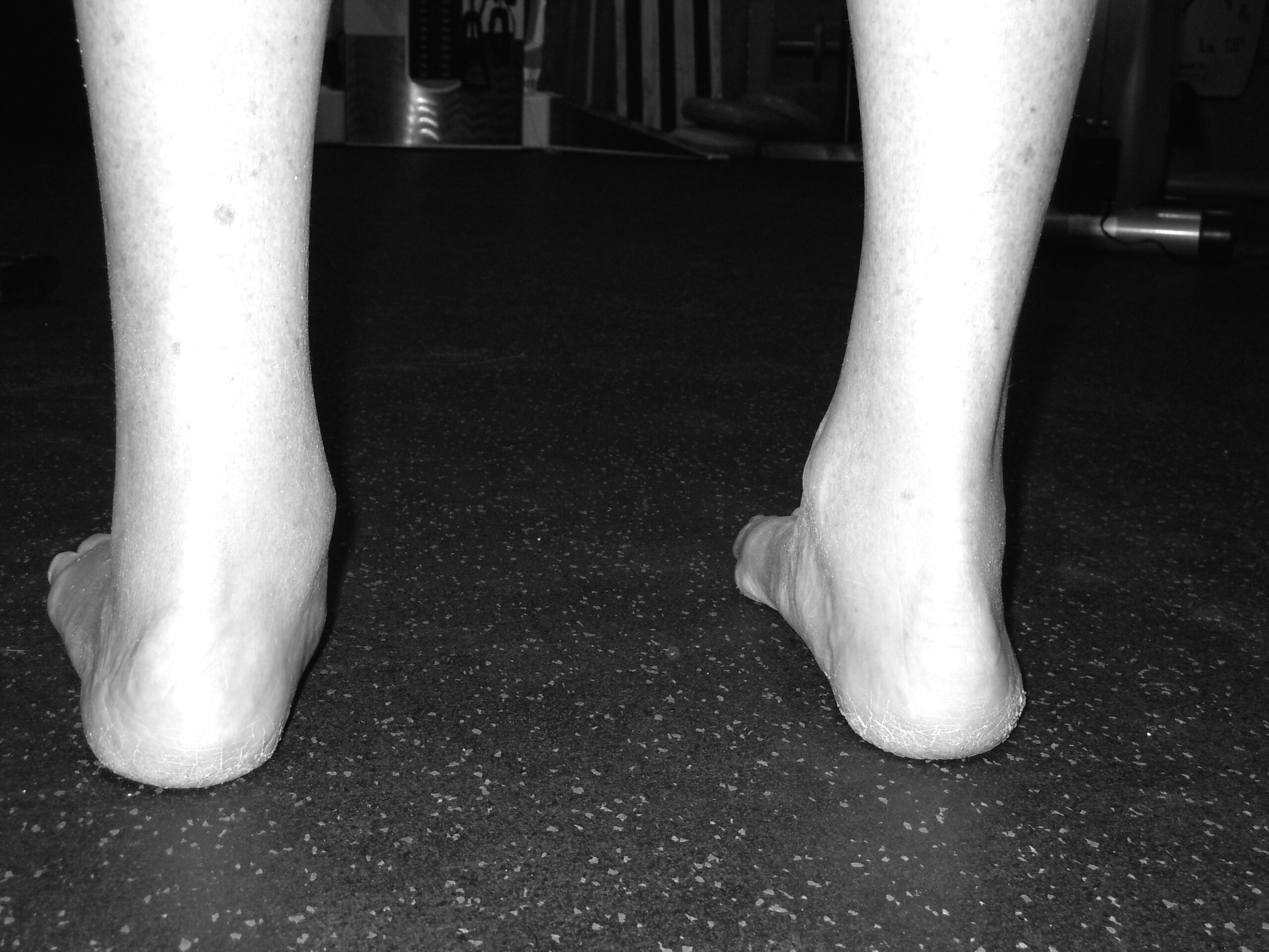 A flat foot and ankle: the arch has dropped and the ankle has collapsed inward