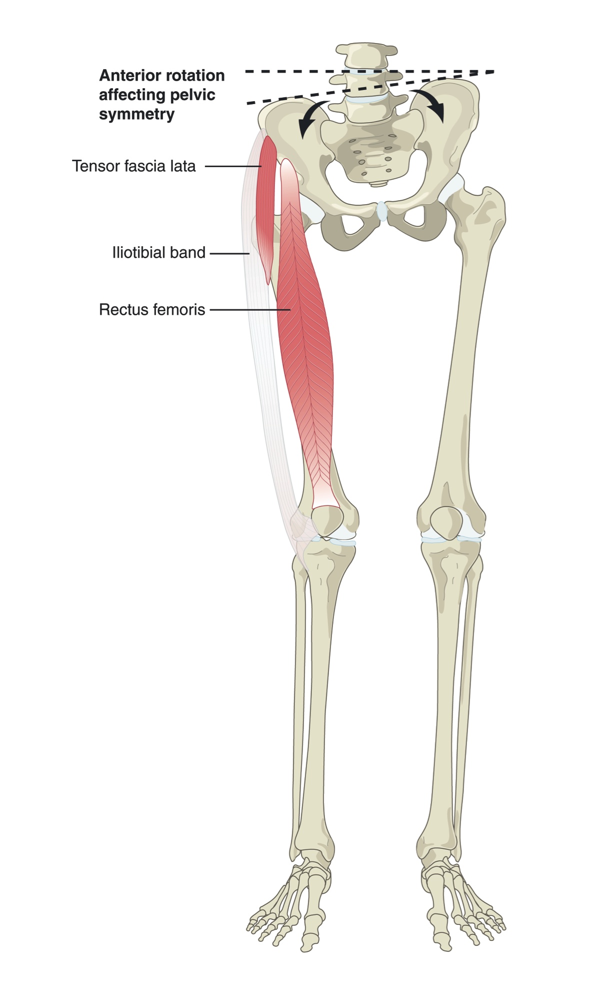 Thigh muscles attaching to the pelvis, pulling it unevenly and affecting the spine above